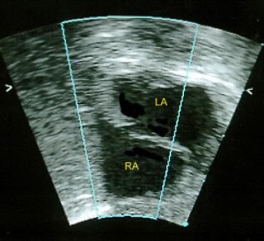 Patent Foramen Ovale: Practice Essentials, Background, Pathophysiology