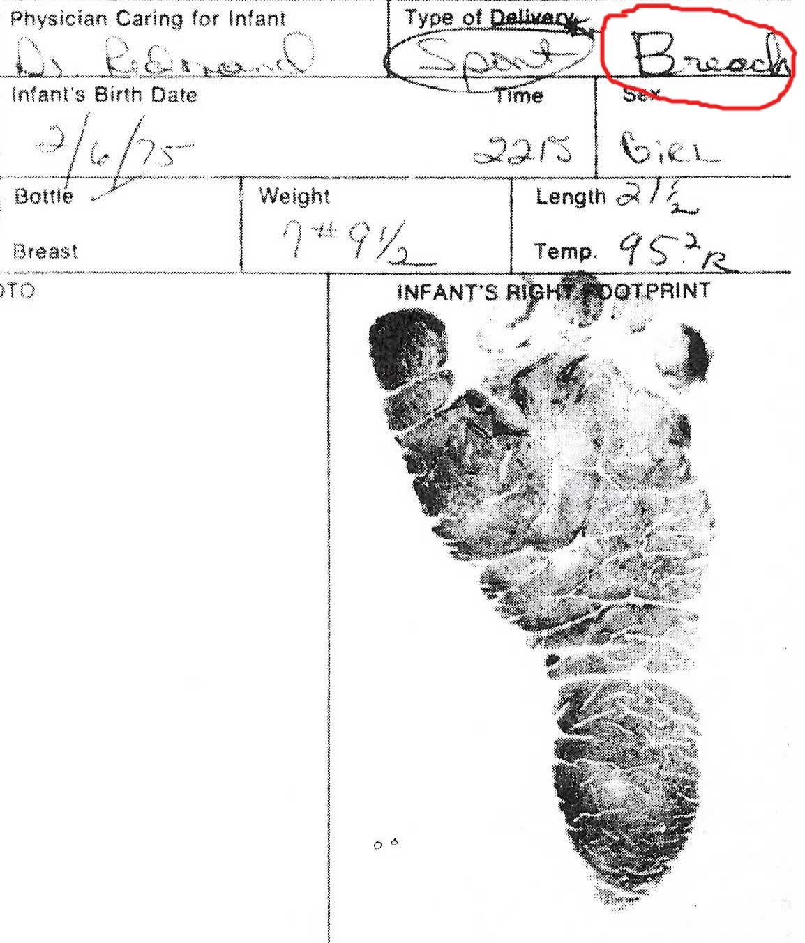 medical record of Karrie's birth, showing a footprint, weight and size, with a note that they were born breach (sic)