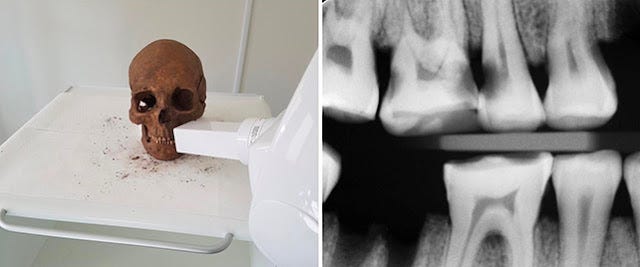 Equipamentos de digitalização modernos foram usados para estudar os dentes. (Carolina Bertilsson/Henrik Lund) Equipamentos de digitalização modernos foram usados para estudar os dentes. (Carolina Bertilsson/Henrik Lund)