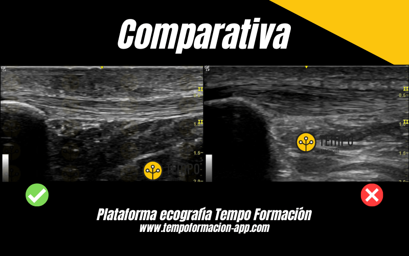 3. Comparativa Corte Longitudinal Ecografia Tempo Formacion.png