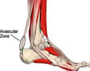 Achilles tears occur most often on this avascular zone