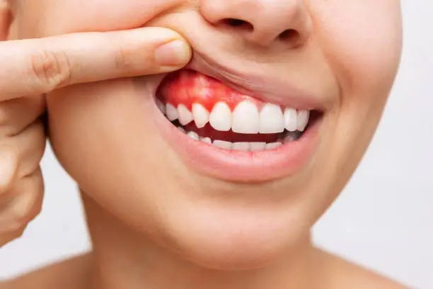 Why Is My Gum Swollen Around One Tooth? - Kuljic DDS & Team