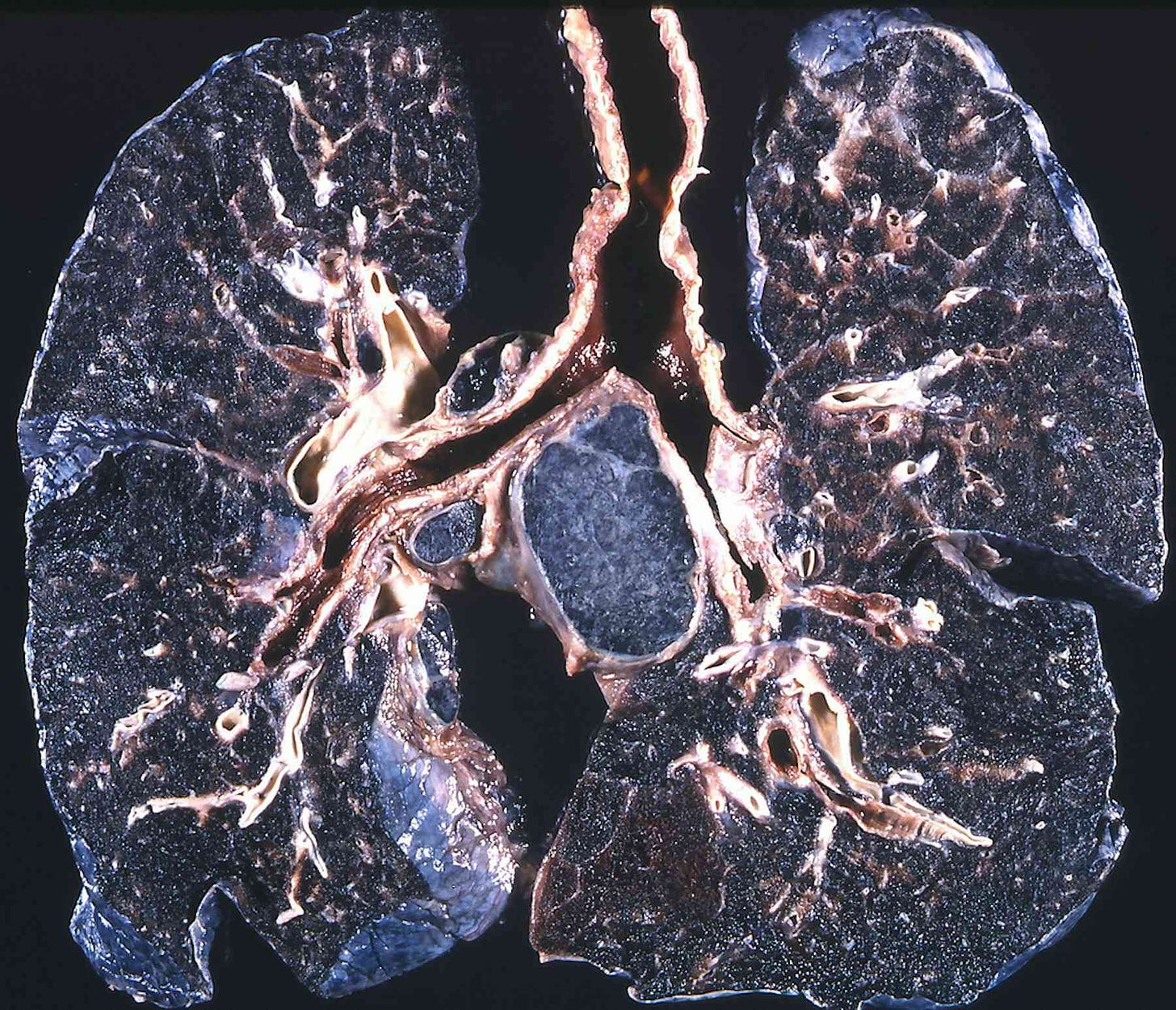 Black lung disease on the rise: 5 questions answered