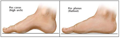 foot type and plantar fasciitis 