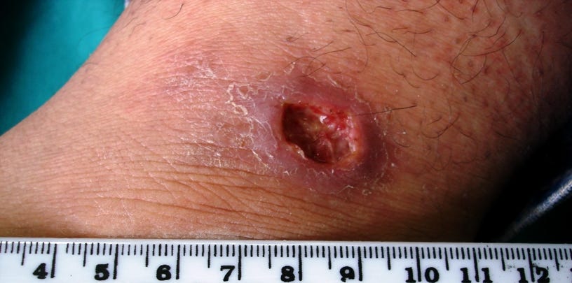 File:Cutaneous Leishmaniasis.jpg - Wikimedia Commons