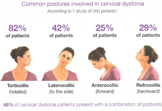 Dystonia - DIANN SHADDOX FOUNDATION for ESSENTIAL TREMOR Research