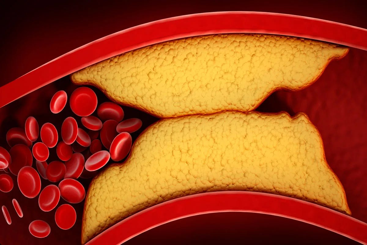 3D visualisation of thickened arteries and veins filled with cholesterol.