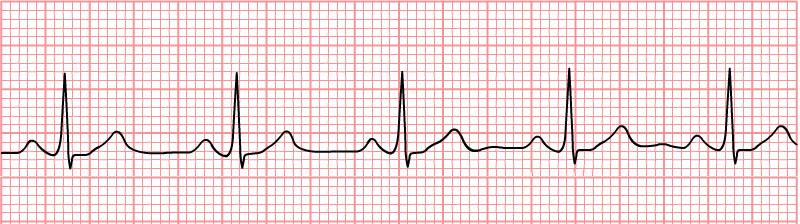 File:Normal Sinus Rhythm Unlabeled.jpg - Wikimedia Commons