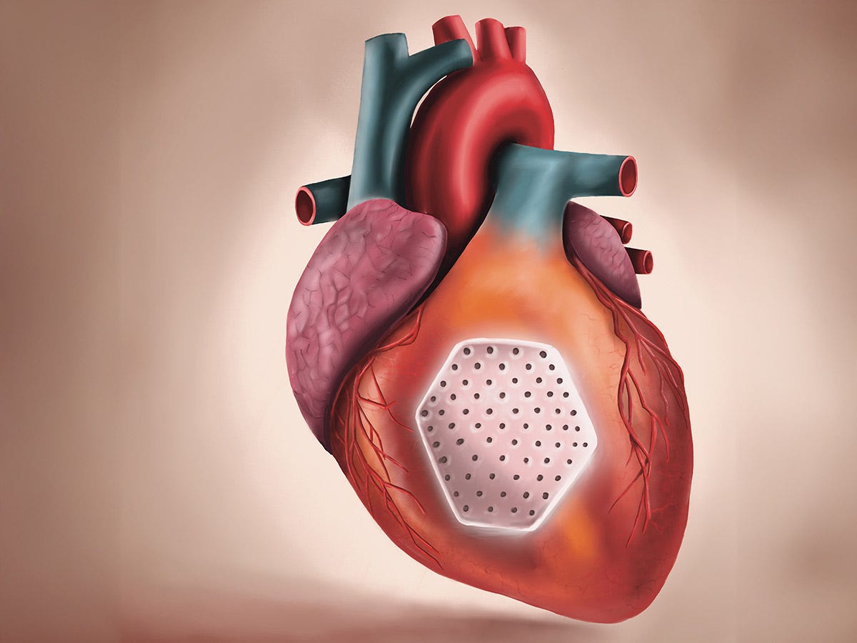 For the 99%, allografts can patch up failing heart | BioWorld