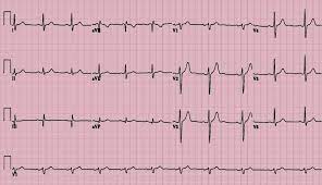 EKG: What is it and what does it mean? – JP Stroke Foundation