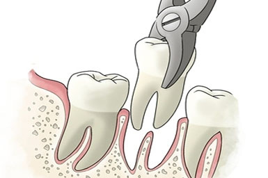 Dental Extraction, What You Can Expect During the Procedure