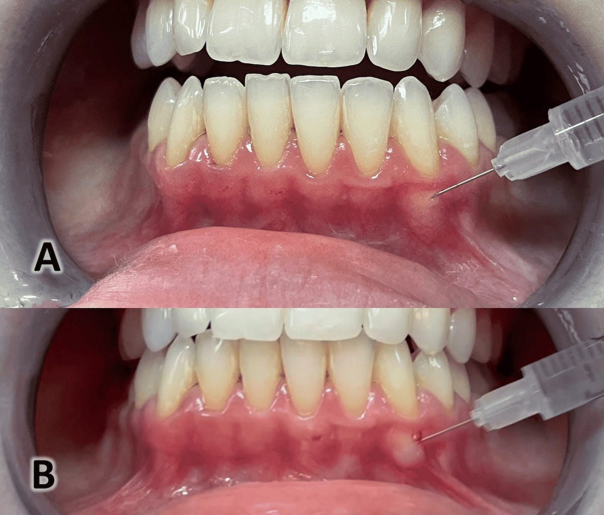 acido hialuronico, papila interdental acido hialuronico, papila interdental