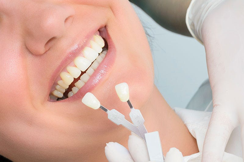 porcelain veneers – Valencia Dental Care