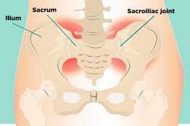Sacroiliac (SI) Joint Pain: Understanding Causes, Symptoms, Treatment