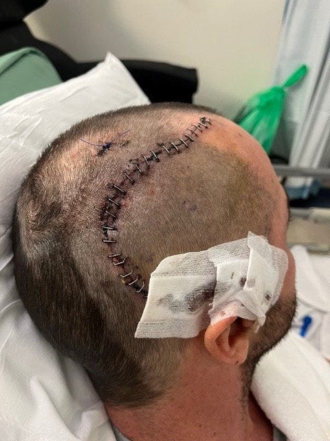 Adam sports a strong surgery scar after going under the knife for the brain tumour