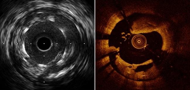 OCT, IVUS Each Boost Long-term Outcomes When Used to Guide PCI, Study  Suggests | tctmd.com
