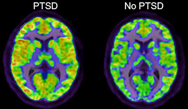New PTSD study identifies potential path to treatment | YaleNews