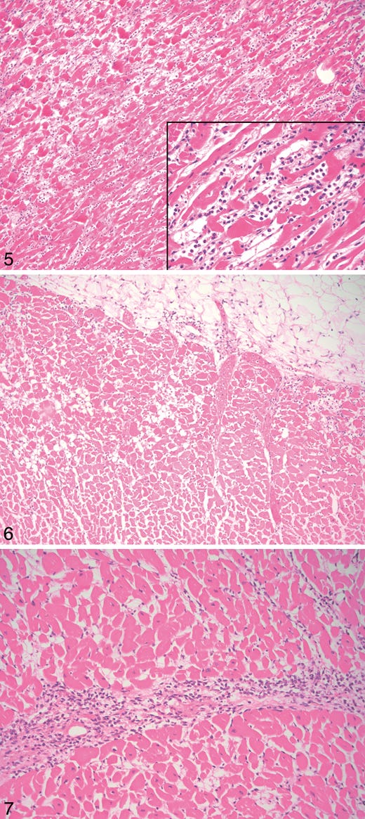 Case B, heart: hypereosinophilic myocytes, contraction band necrosis, and coagulative myocytolysis. Inset: the infiltrate is predominantly neutrophilic (hematoxylin-eosin, original magnifications ×100 and ×400 [inset]).