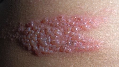 Picture of shingles on lighter skin