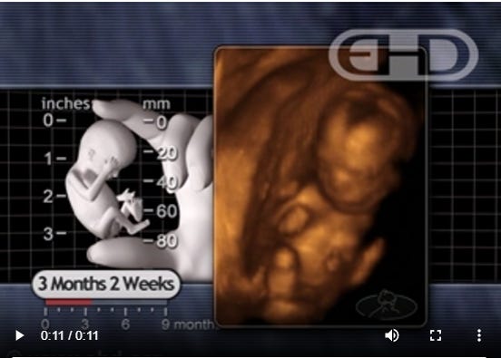 sonogram at 14 wks Sex Selective Abortion