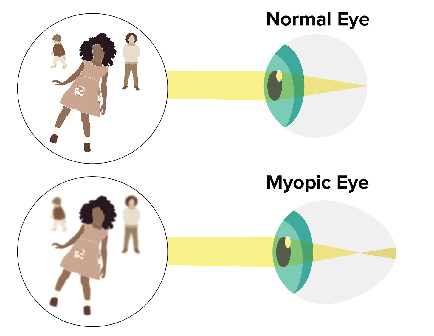 What is Myopia - Insight Vision Center Optometry