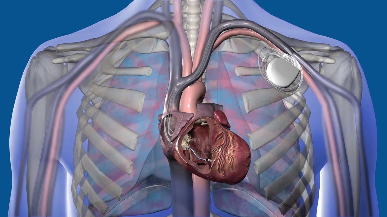 Cardiac Resynchronization Therapy - Phoenix, AZ & Tempe, AZ: Arizona Heart  Arrhythmia Associates