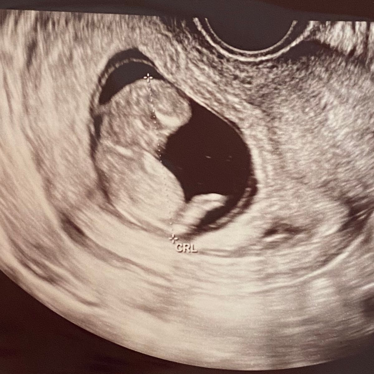 An ultrasound image of a fetus in the womb.