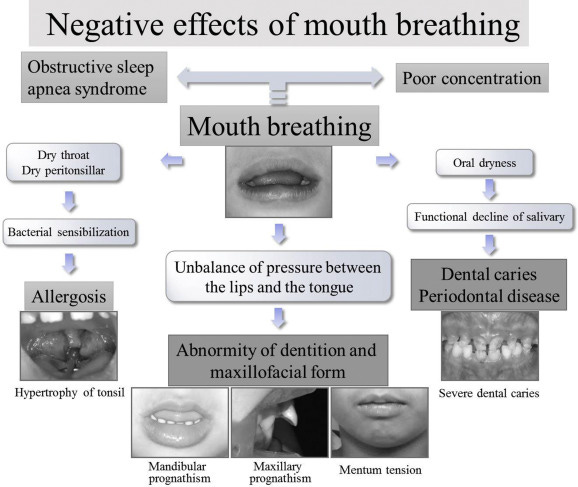 Factors related to mouth-breathing syndrome and the influence of an  incompetent lip seal on facial soft tissue form in children - ScienceDirect