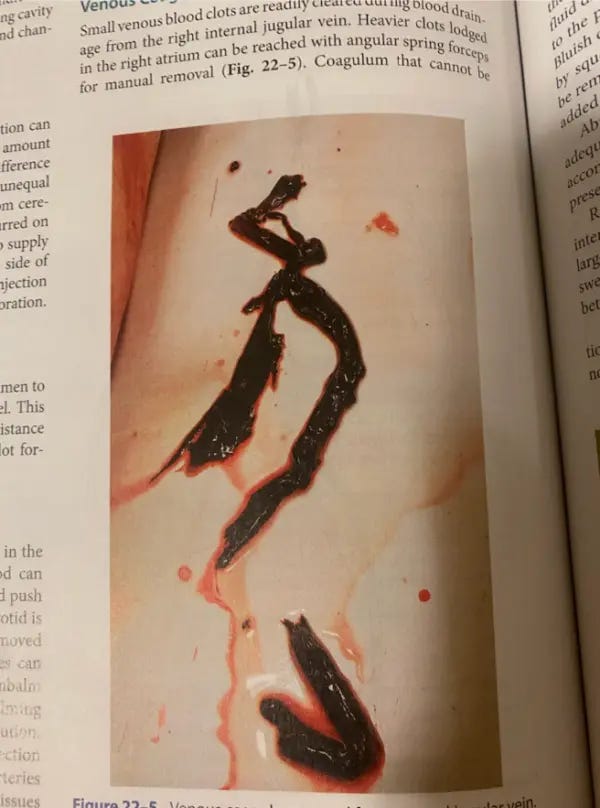 A page from Sarah's embalming textbook that shows what a normal blood clot is supposed to look like. (Courtesy of Sarah)