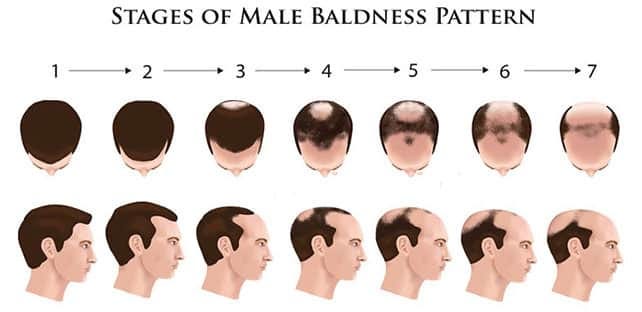 Causes of Male Pattern Baldness and Prevention | Hair sure