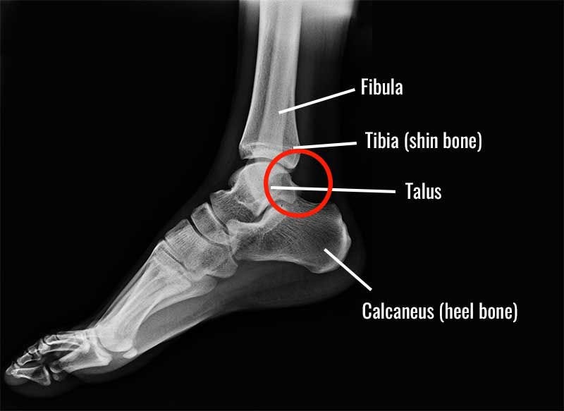 Posterior ankle impingement – Symptoms, tests, and treatment