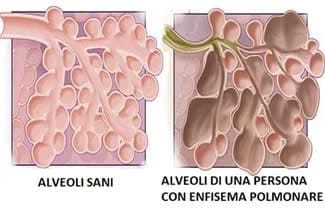 Enfisema Polmonare