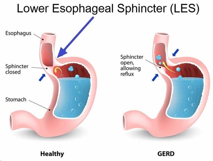 lower esophageal sphincter