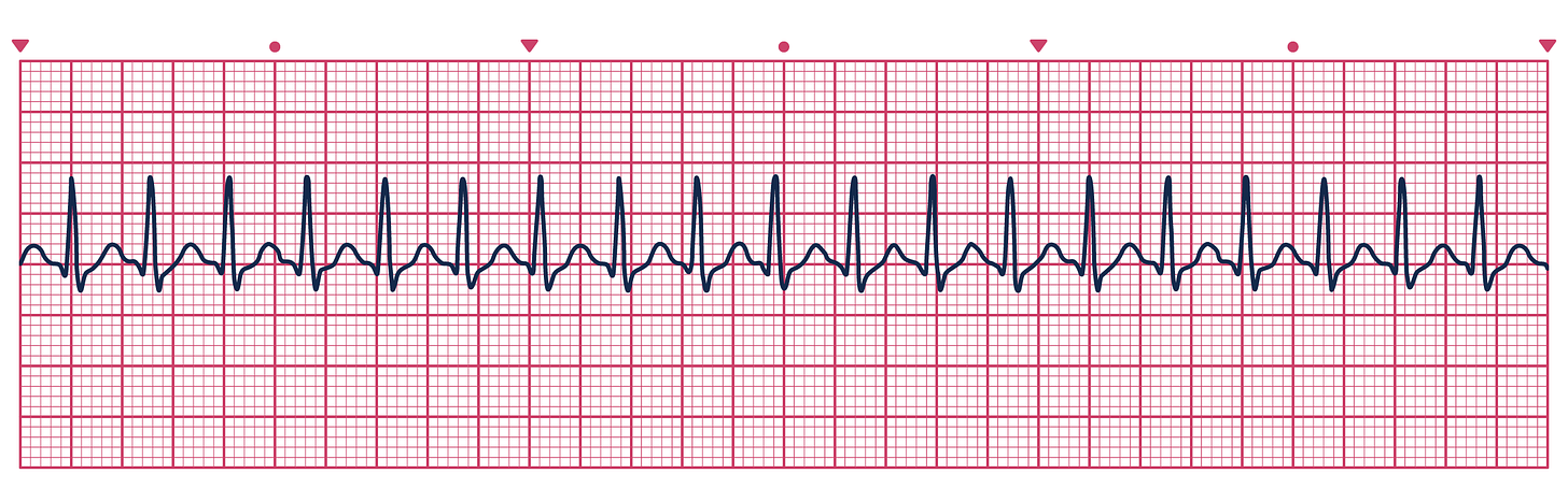 An ECG depicting Supraventricular Tachycardia