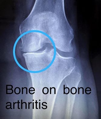 "Bone on Bone" - Comprehensive Orthopaedics