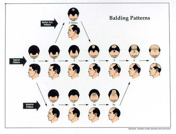 Figure 8. . The Hamilton-Norwood classification of male androgenetic alopecia.