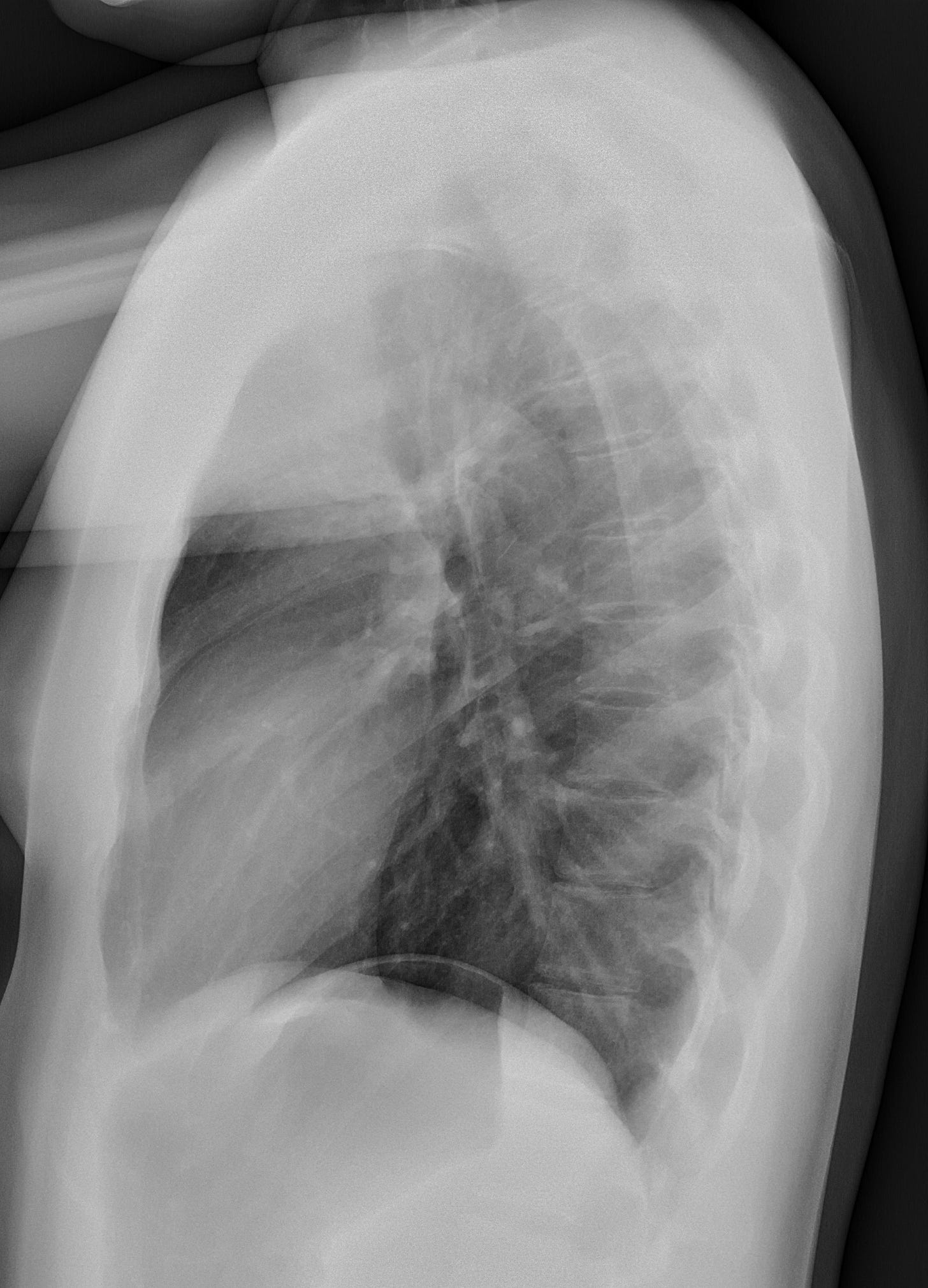 File:Normal lateral chest radiograph (X-ray).jpg - Wikipedia