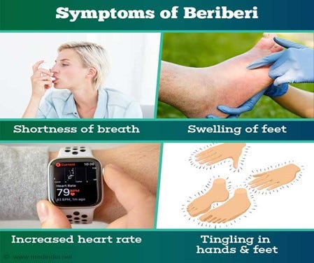 Symptoms of beriberi 