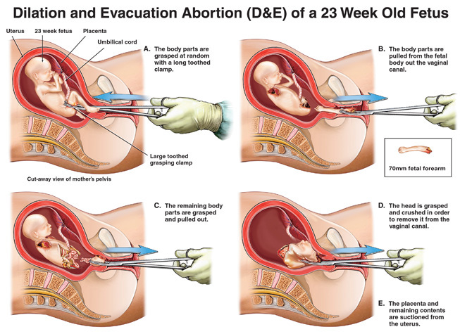 diagram of D&E procedure, showing fetal dismemberment