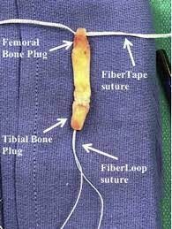 Patellar Tendon Graft Anterior Cruciate Ligament Reconstruction Technique  With Suture Tape Augmentation