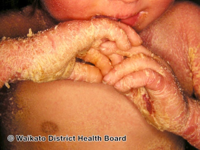 A picture of the hands of a young child with the symptoms of epidermolytic ichthyosis, showing extremely flaky skin and callouses on their palms.