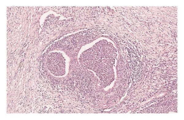 Microabscess in vestigial remnants.