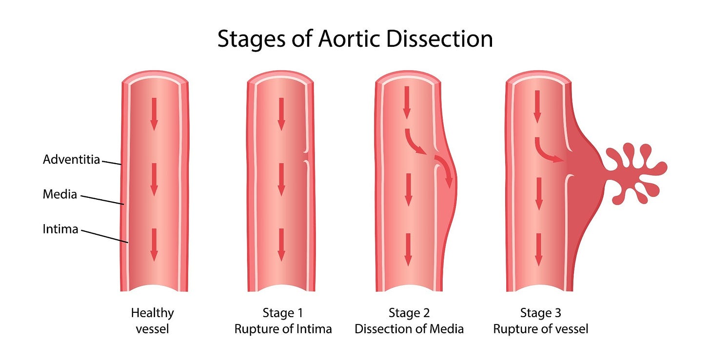 An Overview of Aortic Dissection