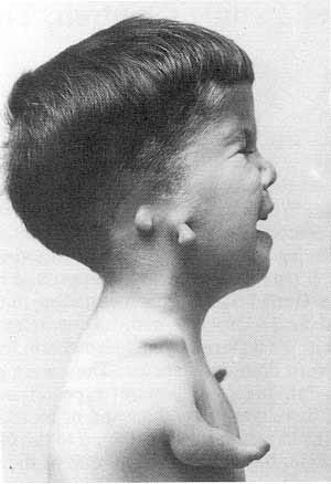 Thalidomide tragedy: the story and lessons … – Chiralpedia Thalidomide tragedy: the story and lessons … – Chiralpedia