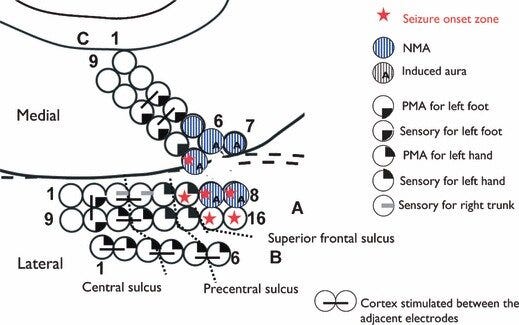 Seizure-onset zone and cortical mapping in Patient 2. Ictal onset zone... | Download Scientific ...