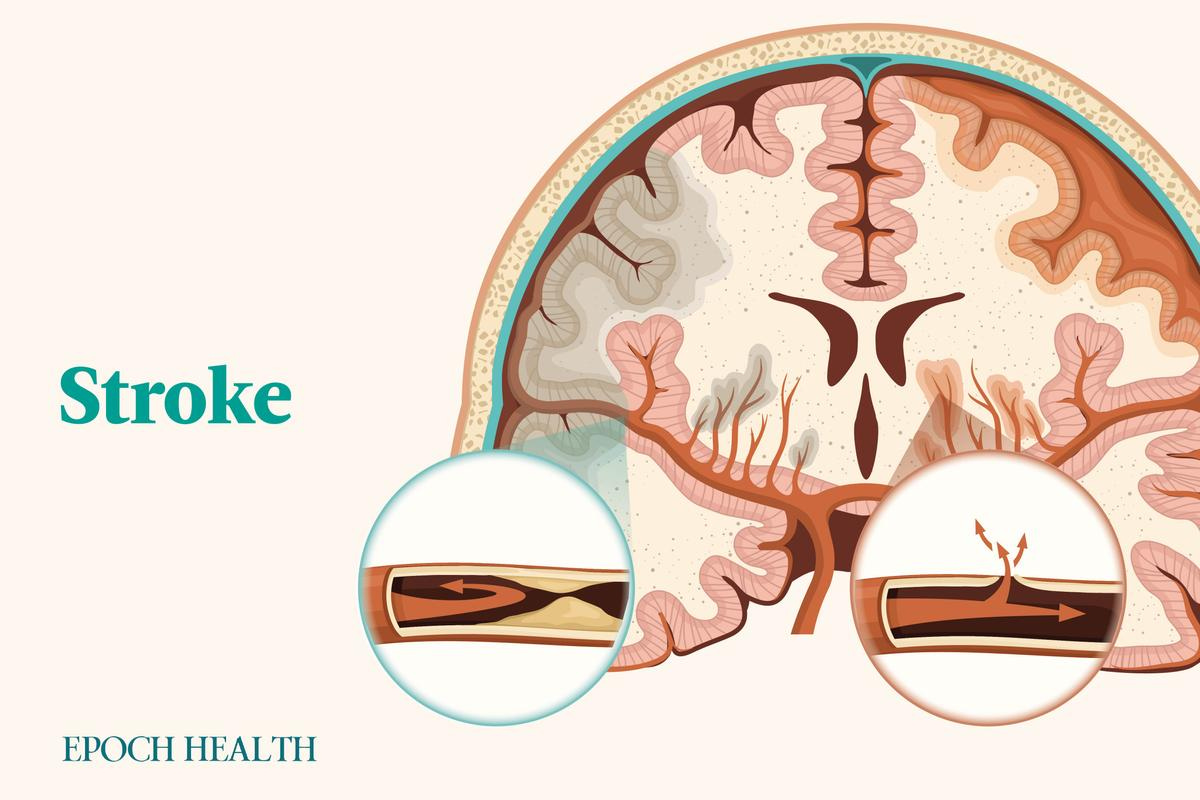 The Essential Guide to Stroke: Symptoms, Causes, Treatments, and Natural Approaches