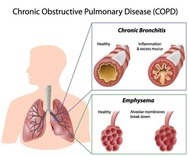 COPD | Asthma Foundation NZ