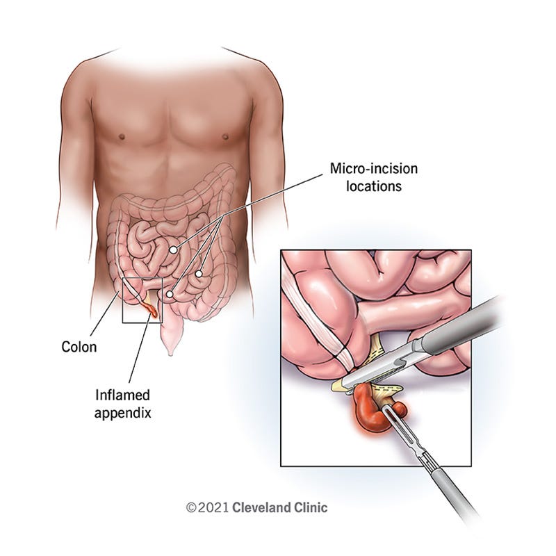 Appendectomy (Appendix Removal): Surgery & Recovery