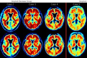 Comparison of baseline (upper row) and follow-up (lower row) FBB-PET uptake patterns in Aβ-decrease and Aβ-increase groups. The Centiloid scale, introduced by the Global Alzheimer’s Association Interactive Network, is a standardized quantitative measurement for amyloid PET imaging. Red indicates higher levels of uptake, while blue indicates lower levels. Figure is available in color online only.