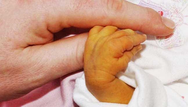 picture of newborn skin tone with jaundice